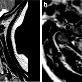 Sagittal A And Axial T Weighted Images B Highlighting