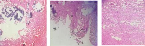 Dentigerous Cyst Accompanied By A Calcifying Epithelial Odontogenic