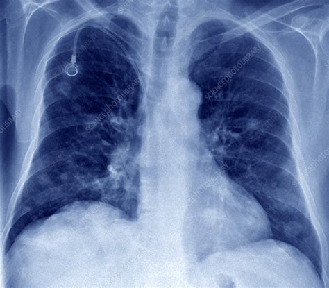 Secondary Lung Cancer X Ray Stock Image C029 4667 Science Photo