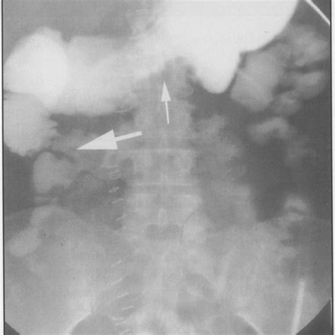 (PDF) Duodenal stents for malignant duodenal strictures