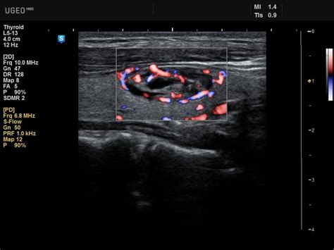 Ultrasound Images • Thyroid S Flow Echogramm №626