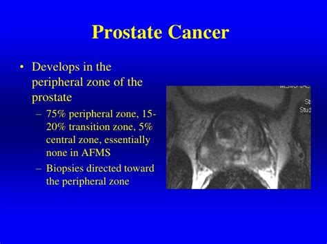 Current Diagnosis And Management Of Prostate Cancer