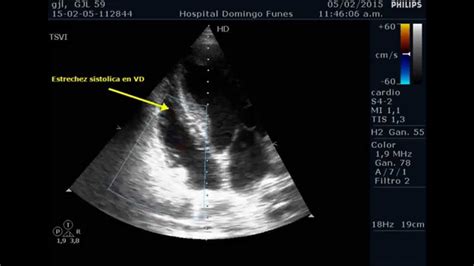 Estenosis Ao Severa Iao M Hipertrofica Dr Pedro Guillermo Bustos 8