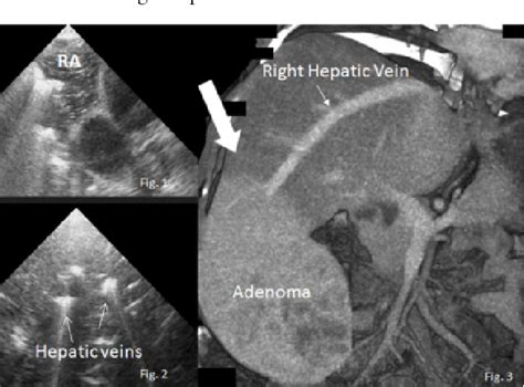 Figure From Argon Gas Embolism With The Use Of Argon Beam Coagulation