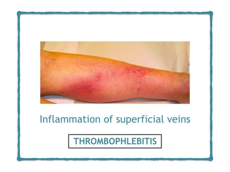 Complications Of Varicose Veins - Dr Avinash Katara Minimal Access Surgeon