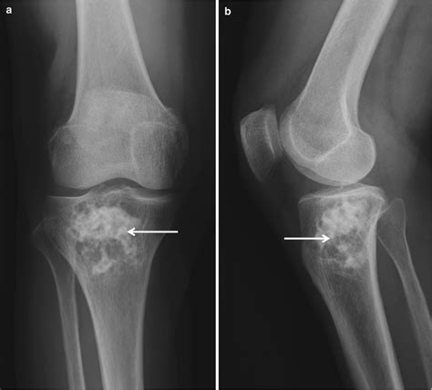 Chondrogenic Tumors Oncohema Key