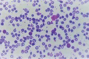 Peripheral Smear At Magnification Shows Red Blood Cells Rbcs