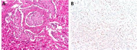 Figure 2 From CAMTA 1 Expression In 24 Cases Of Hepatic Epithelioid