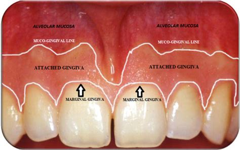 Other Conditions Affecting The Periodontium Flashcards Quizlet