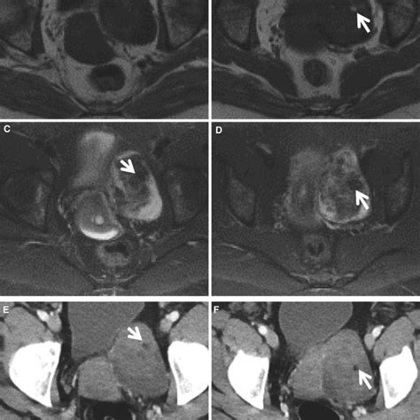 Degenerated subserosal fibroid exophytic from the lower uterine segment ...