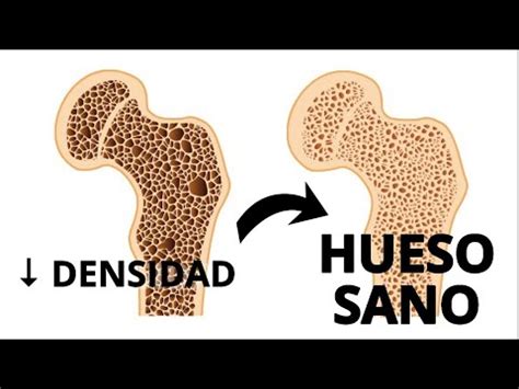 COMO GANAR DENSIDAD OSEA Y PREVENIR OSTEOPOROSIS EN 3 PASOS YouTube