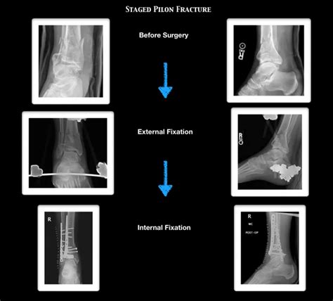 Pilon Fractures Robert Sheinberg Dpm Weston Fl Podiatrist