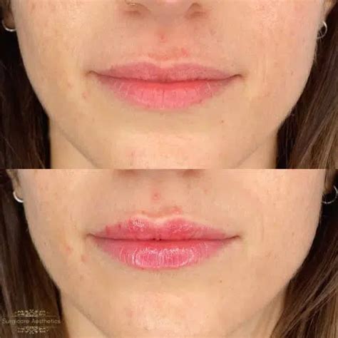 Lip Fillers Barnet And Marylebone London Surgicare Aesthetics