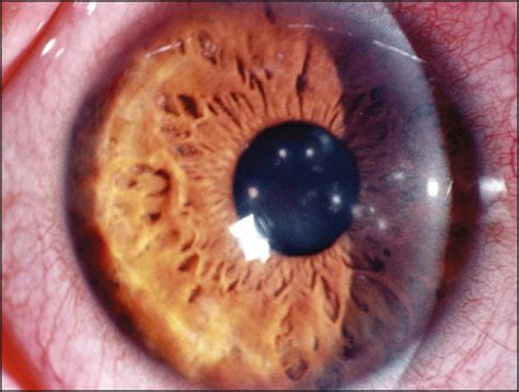 Nocardia Keratitis In A Contact Lens Wearer Cornea Jama Ophthalmology The Jama Network