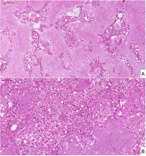 Calcifying Epithelial Odontogenic Tumor Histology