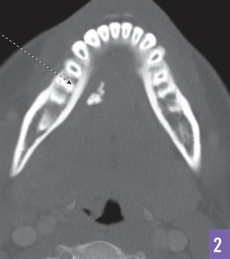 Submandibular Sialolith Consultant360