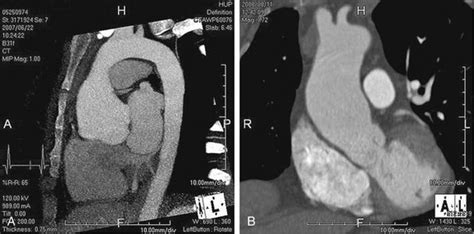 Thoracic Aortic Aneurysms Radiology Key