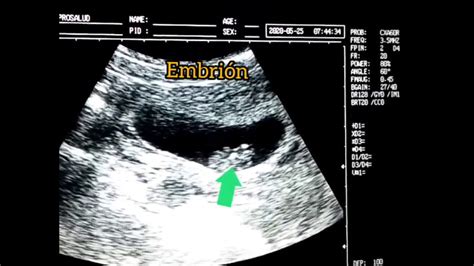 EmbriÓn De 10 Semanas AsÍ Se Ve Un Embrion De 10 Semanas Embarazo De