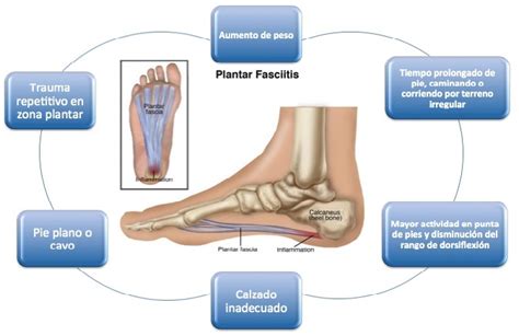 Fascitis Plantar Causas Y Tratamiento Bulevip