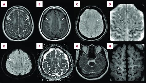 A Year Old Female Patient With Vwmd A B Axial T Weighted And