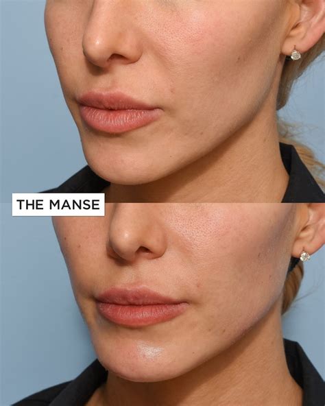 Jawline Dermal Filler Best Clinic Sydney For Dermal Fillers