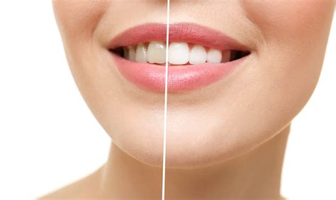 3 Steps To A Brighter Whiter Smile Tigard Or Appletree Dentistry