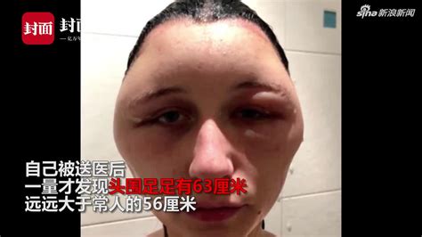 巴黎女生使用染发剂后过敏 脑袋肿成外星人 图 含视频 手机新浪网