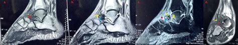 Osteoblastoma Of Talus A Diagnostic Dilemma Abstract Europe PMC