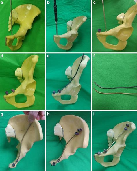 Conventional Plate Fixation Versus Minimally Invasive Modified Pedicle