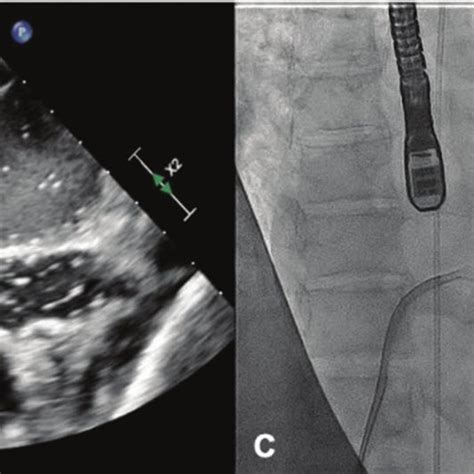 Percutaneous Balloon Mitral Valvuloplasty | Download Scientific Diagram