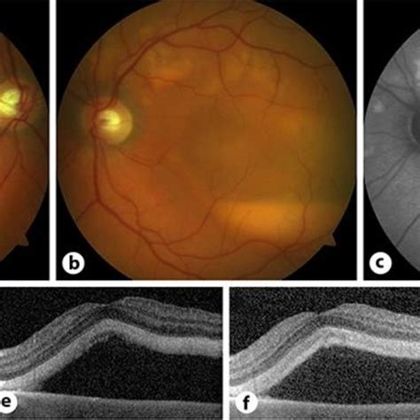 A B Color Fundus Photographs Of The Right And Left Eyes Demonstrating