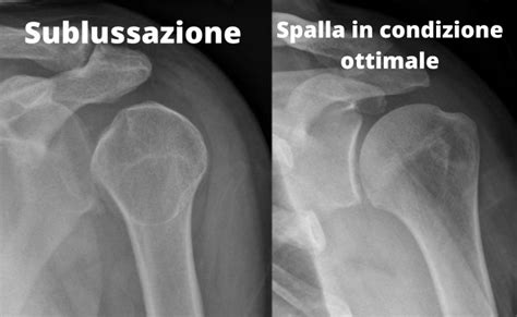 La Sublussazione Di Spalla La Fenice Centro Riabilitativo