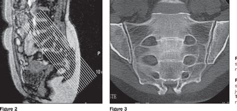 Figure 4 From Sacroiliitis Imaging Evaluation Semantic Scholar