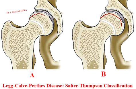 Legg-Calve-Perthes Disease - Physiopedia