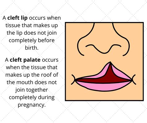 Cleft Lip Diagram