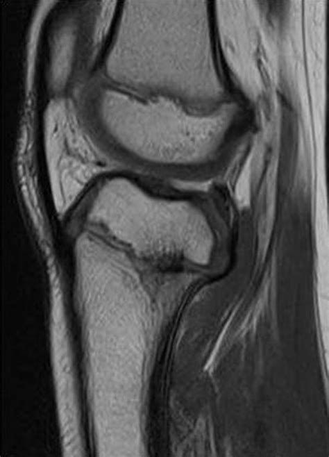 Resection Of A Physeal Bar With Complete Transverse Osteotomy At The