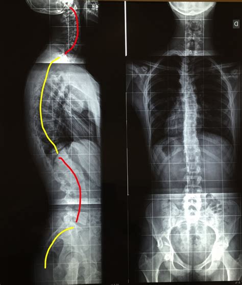 Saiba Tudo Sobre A Estrutura Da Coluna Vertebral Hospital Santa Marcelina