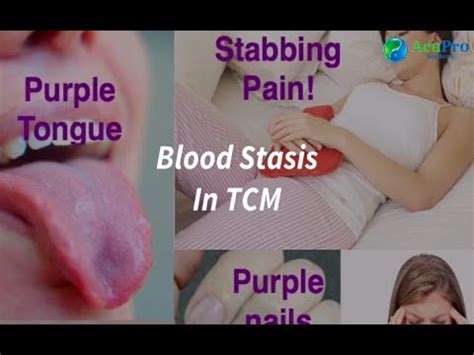 Blood Stasis In TCM YouTube