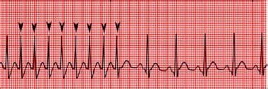 Defibrillation and Cardioversion