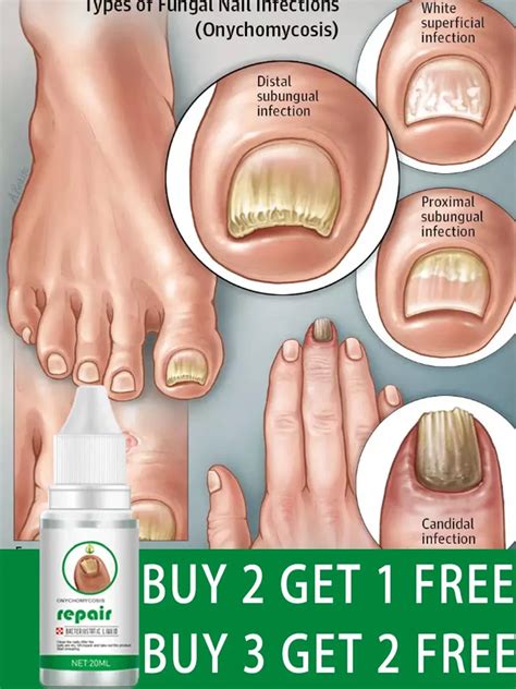 Fungal Nail Treatment Feet Care Essence Nail Foot Whitening Toe Nail