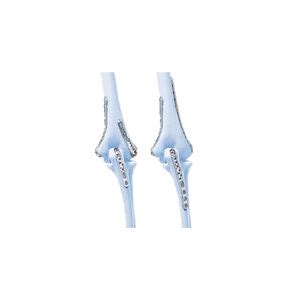 Placca Di Compressione Per Metacarpo Lcp Depuy Synthes Bloccata