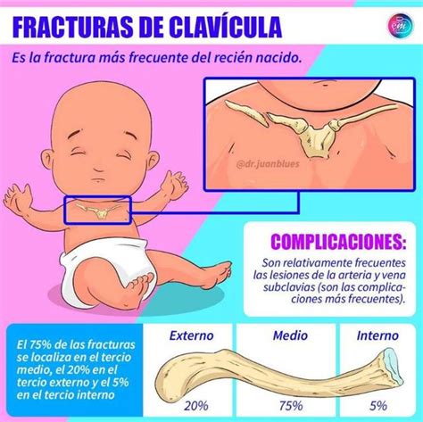 Fractura De Clav Cula Yudoc Org Udocz