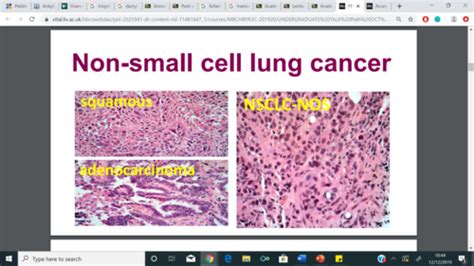 Lung Cancer Pathology Flashcards Quizlet