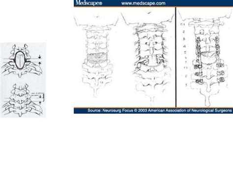 DISH: Diffuse Idiopathic Skeletal Hyperostosis of the spine