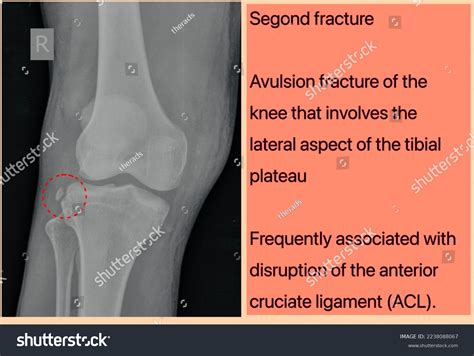 Segond Fracture X Ray Avulsion Fracture Stock Photo 2238088067 ...