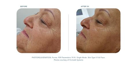 Treatment Skin Rejuvenation Formatk