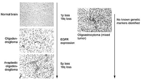 Genetics Of Adult Malignant Gliomas