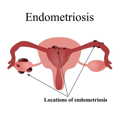 Endometriosis Quistes Endometriales La Estructura De Los Rganos