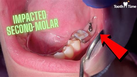 Braces On Impacted Molar Orthodontic Appliance U Loop Tooth