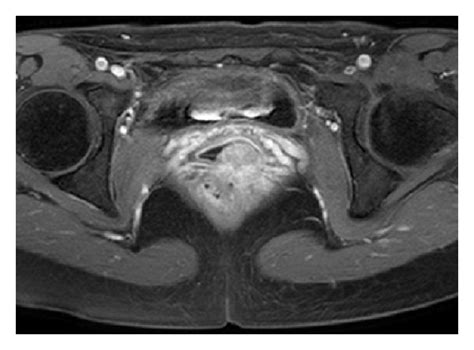 Pelvic Mri A Sagittal Fat Suppressed T Weighted Mr Image After